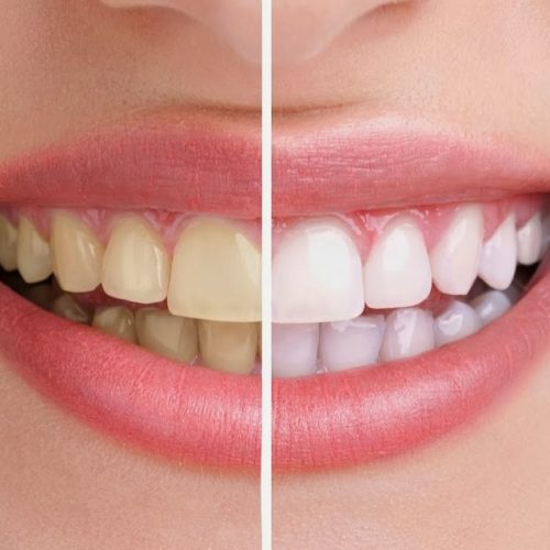DENTS BLANCHIMENT DENTS BLANCHIMENT